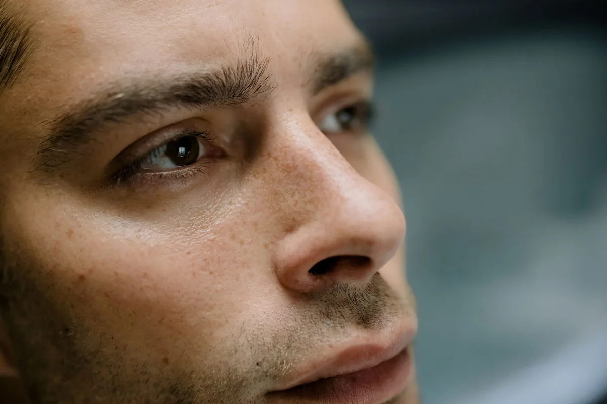 Gros plan sur les symptômes de rougeurs et de vaisseaux dilatés sur le visage